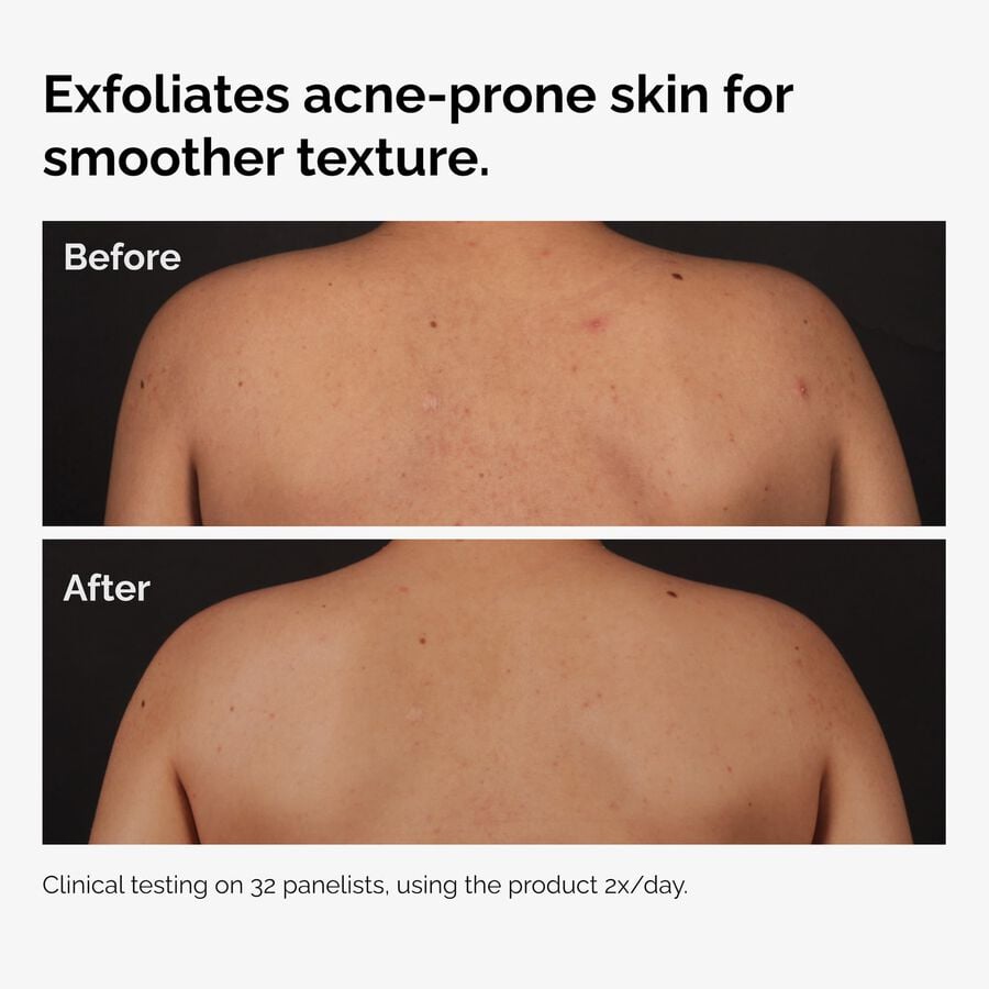 salicylic-acid-0-5-body-serum-u4 ord-salicylic-acid-body-serum-before-after-graphic-NA.jpg